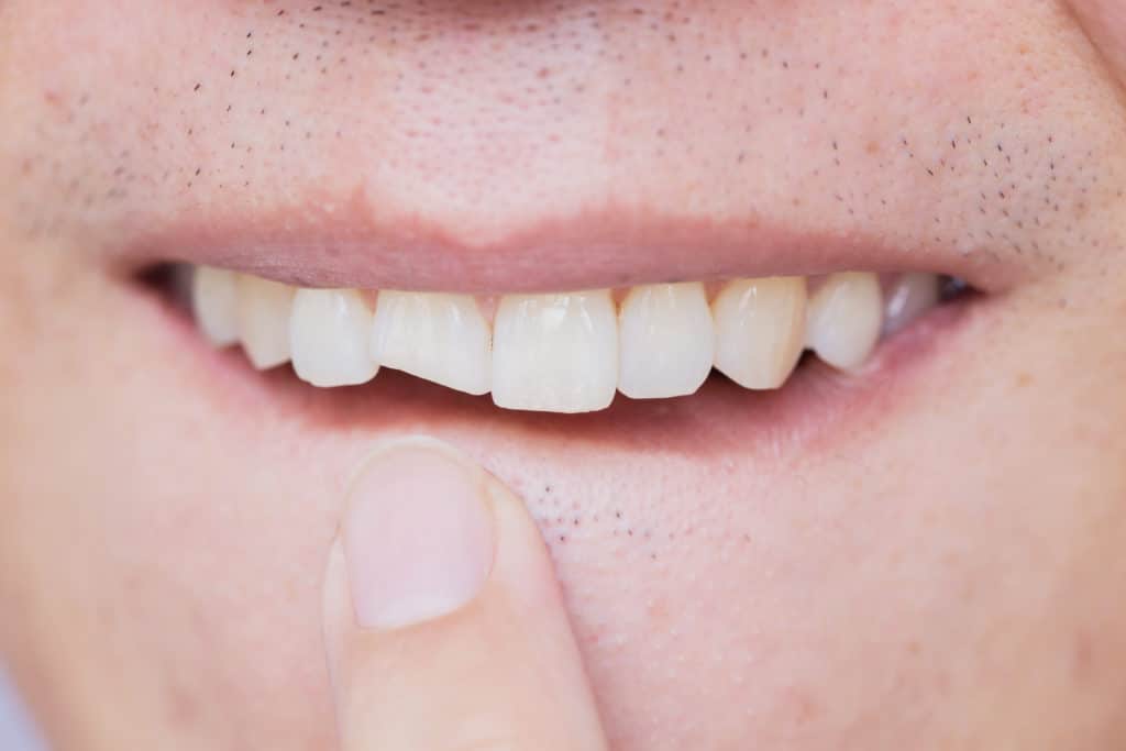 Cracked Teeth cracked teeth David G. Johnson