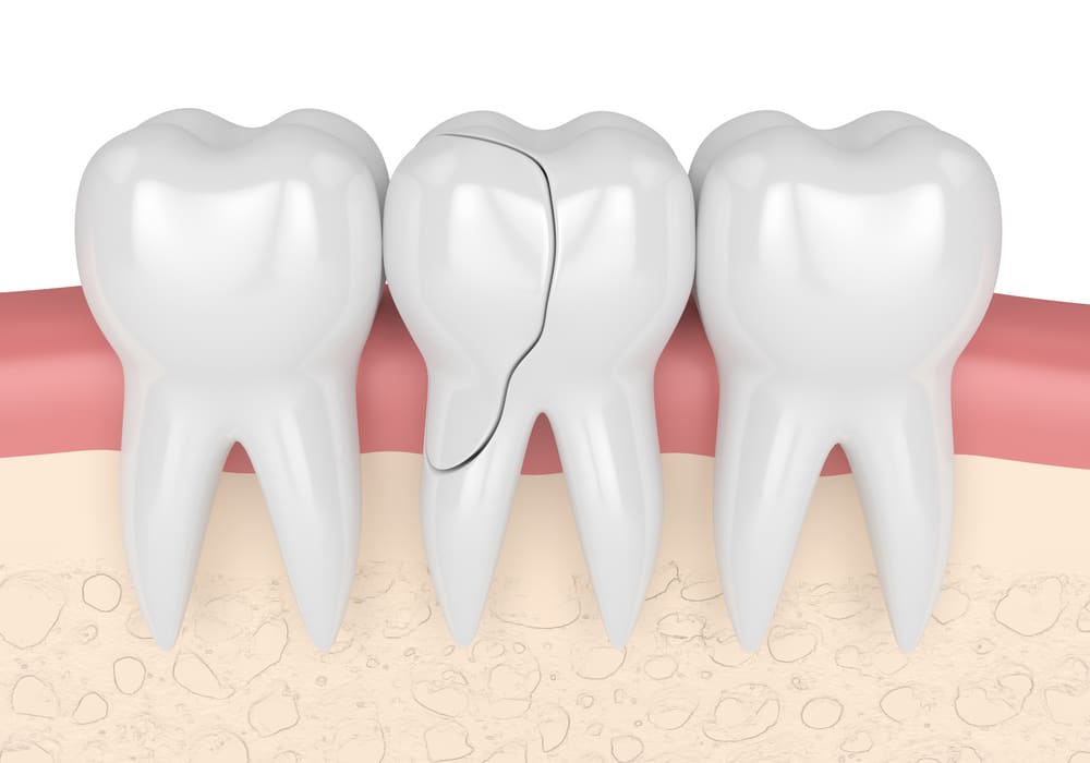 a cracked tooth in centerville, utah