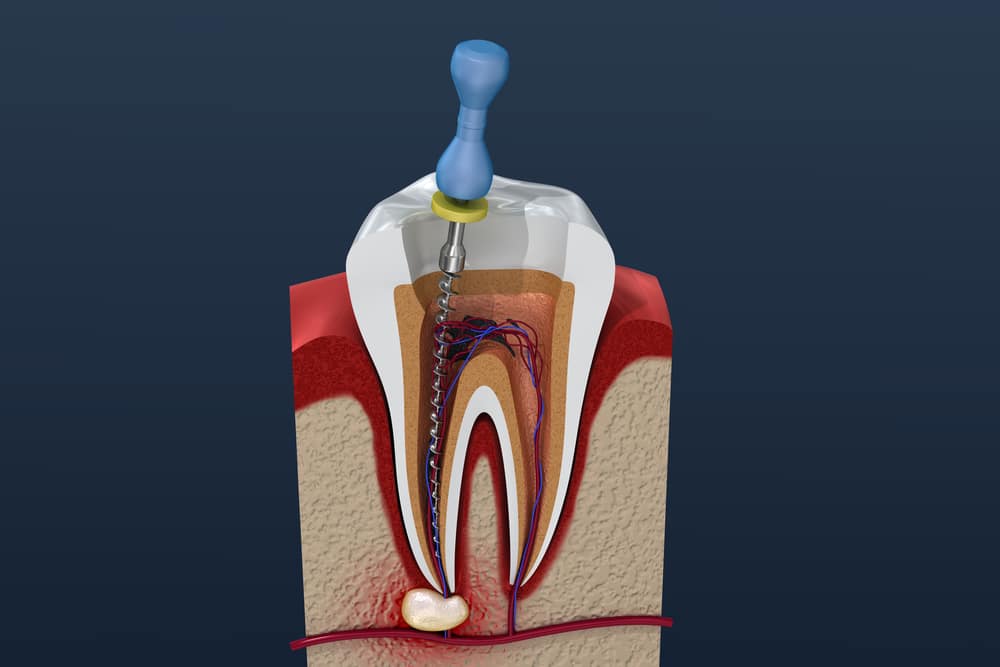 existing crown need a root canal