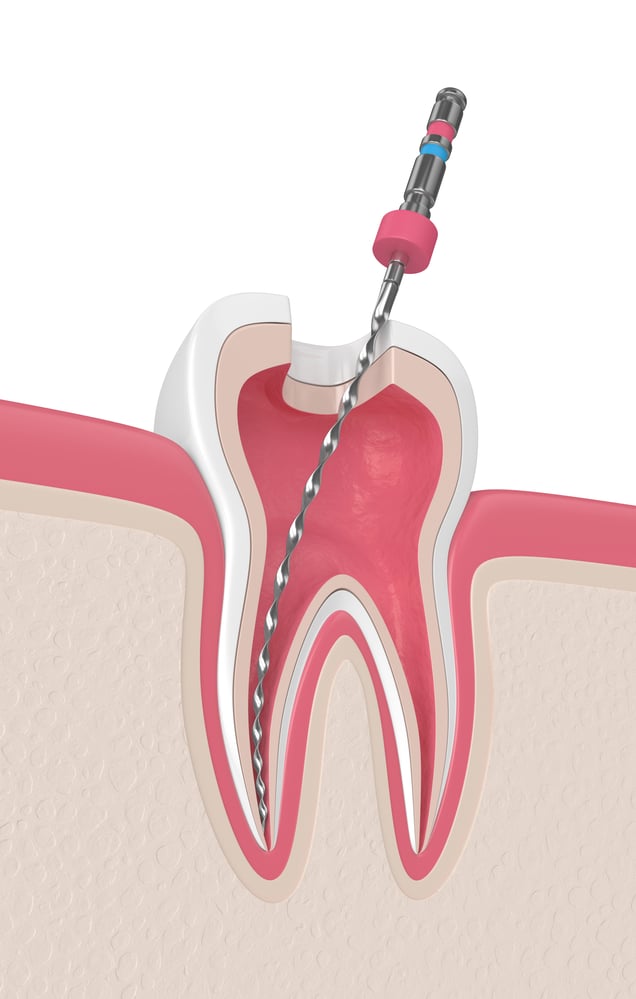 history of root canals