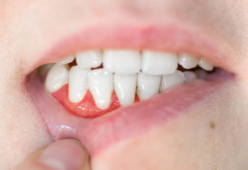The Myth About Root Canals: 6 Common Misconceptions That Make Patients Anxious Myth about root canals