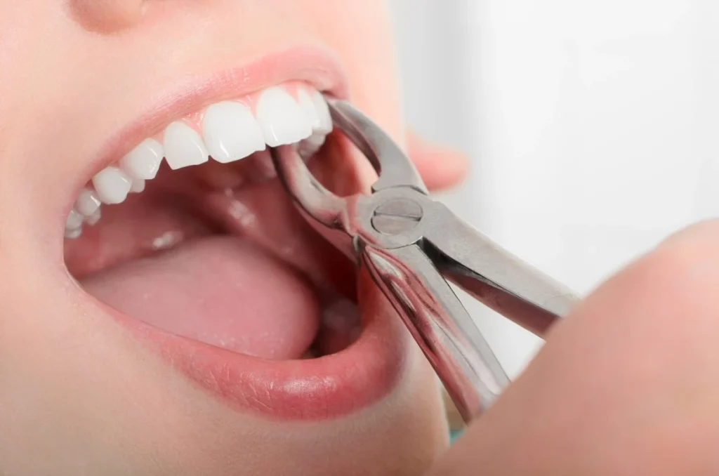 A Tooth Extraction - Layton, Centerville, UT