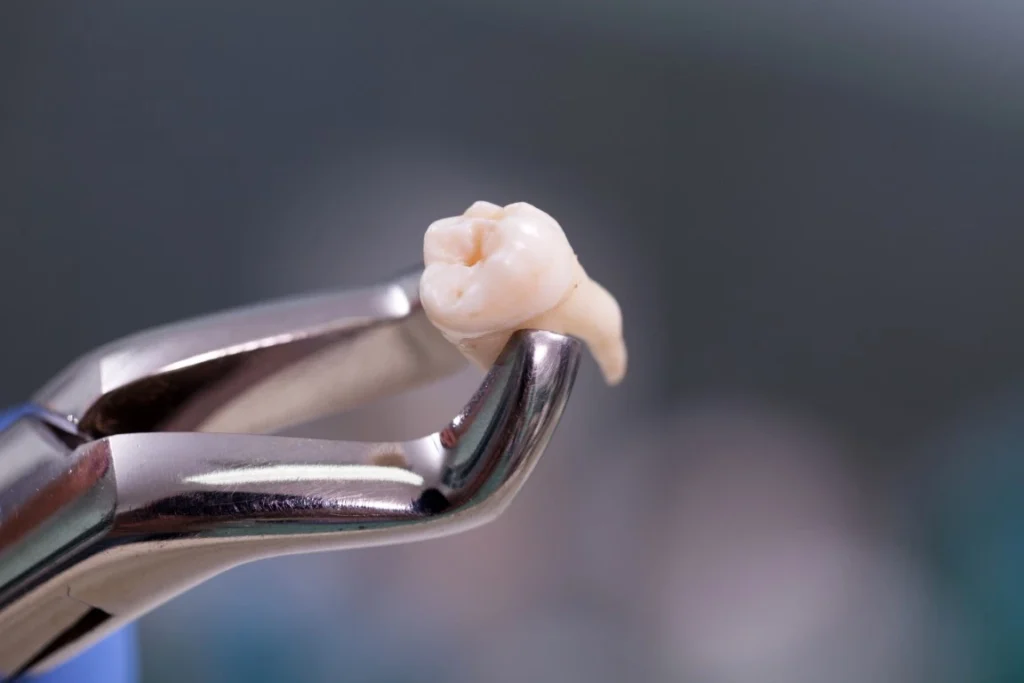 A Tooth Extraction - Layton, Centerville, UT